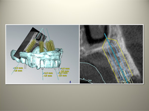 CTによる画像診断とガイド手術