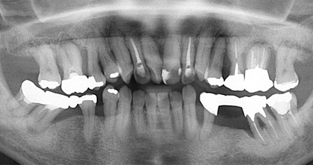進行した歯周病（2）